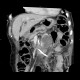 Migration of biliary drain, perforation of duodenum: CT - Computed tomography